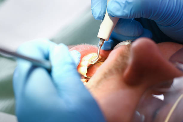 Best Emergency Dental Extractions in USA